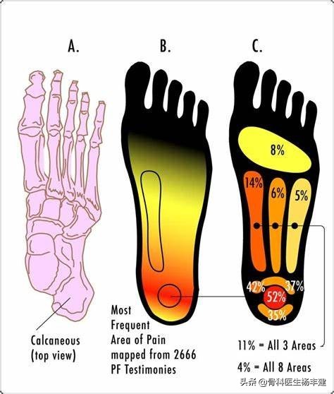 中老年脚后跟疼可以艾灸吗,中老年妇女脚后跟疼痛如何治疗