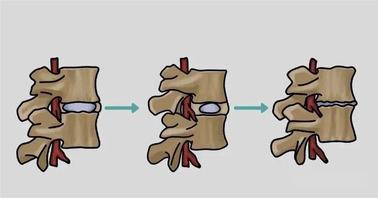 腰椎滑脱的病因,腰椎滑脱症最常见的鉴别诊断