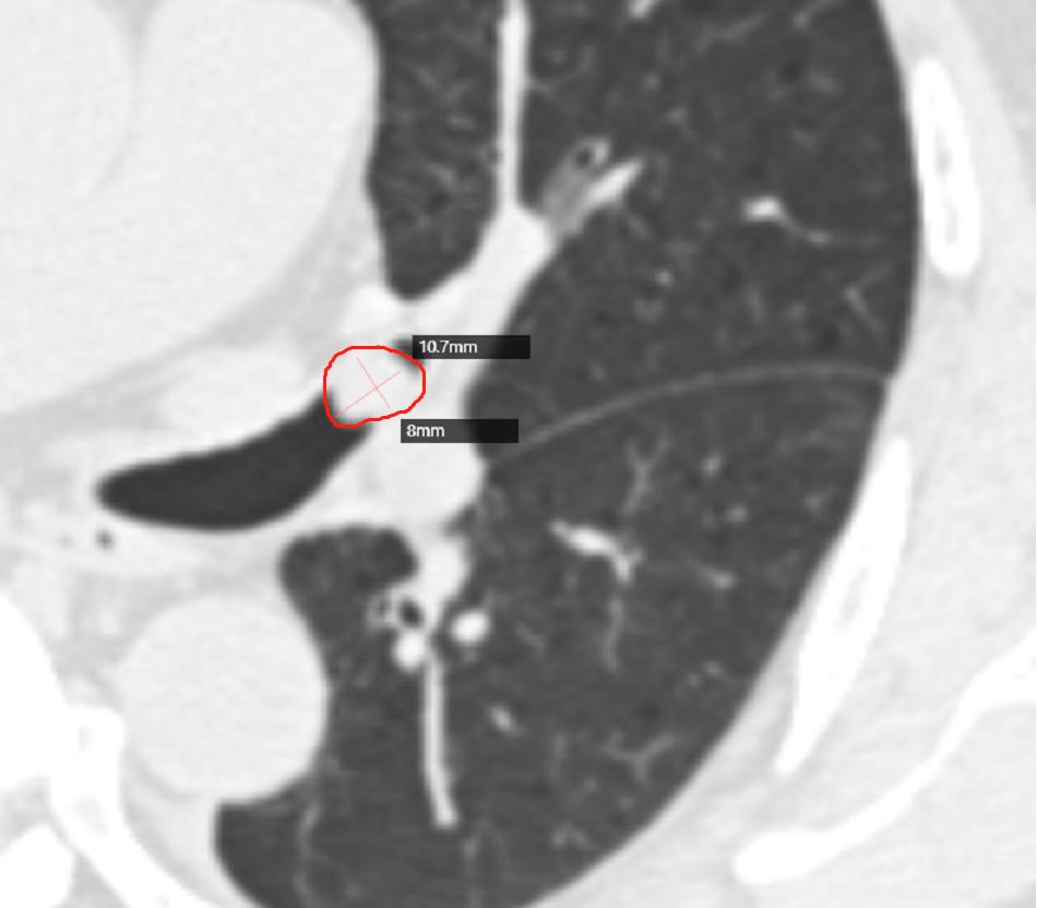 胸腺鳞状细胞癌手术后两年肺转移,胸腺鳞癌转移了能活多久