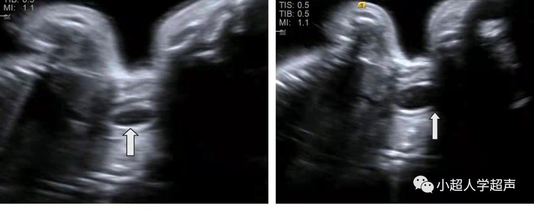 食道闭锁超声表现,食管闭锁一型手术过程