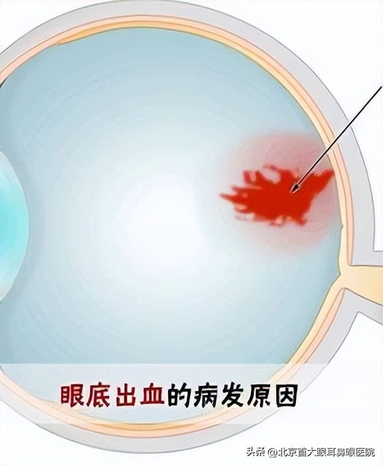 眼底出血是怎么回事？怎么办？北京眼底病哪家医院好？