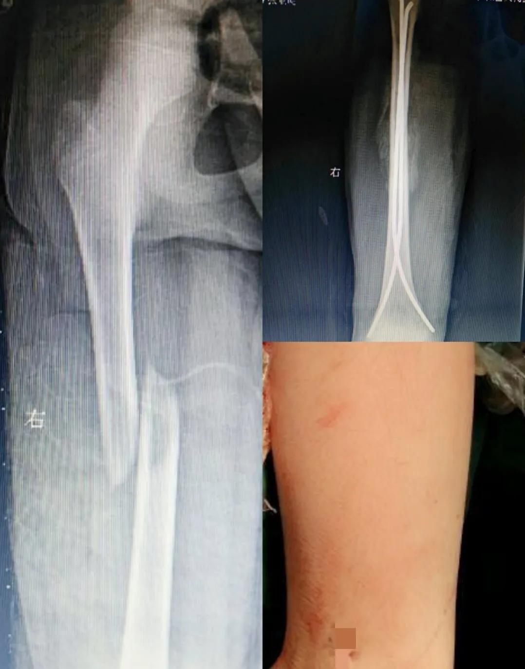 小孩子骨折手术后需要做康复吗,小孩骨折后需要做保护吗