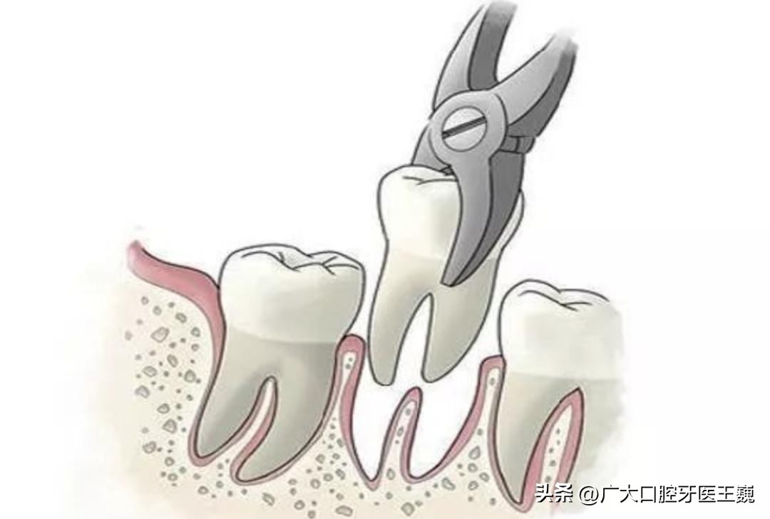 矫正牙齿戴牙套感觉疼痛怎么缓解,牙齿矫正戴牙套牙疼怎么解决