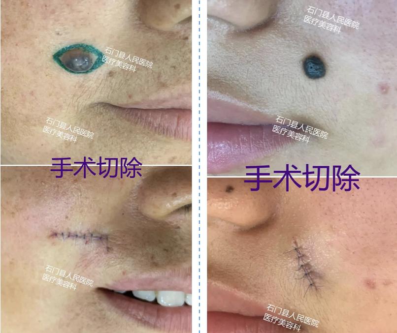 哪些痣应该点哪些痣不应该点,痣多适合什么点痣方法