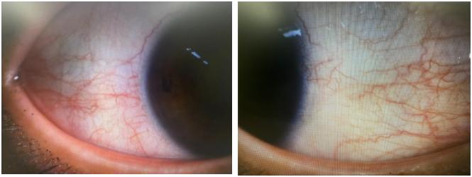 干眼症适合戴隐形眼镜吗,干眼导致畏光吗