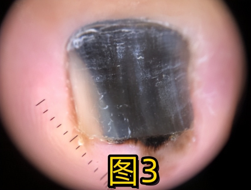 华西专家说，不是转你们，起码有一半的人从没有剪对过指甲儿！