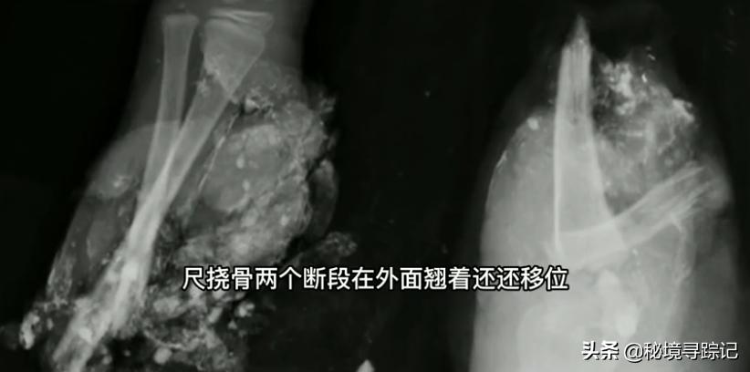 儿童胳膊断了做手术,小孩手臂断了真实手术