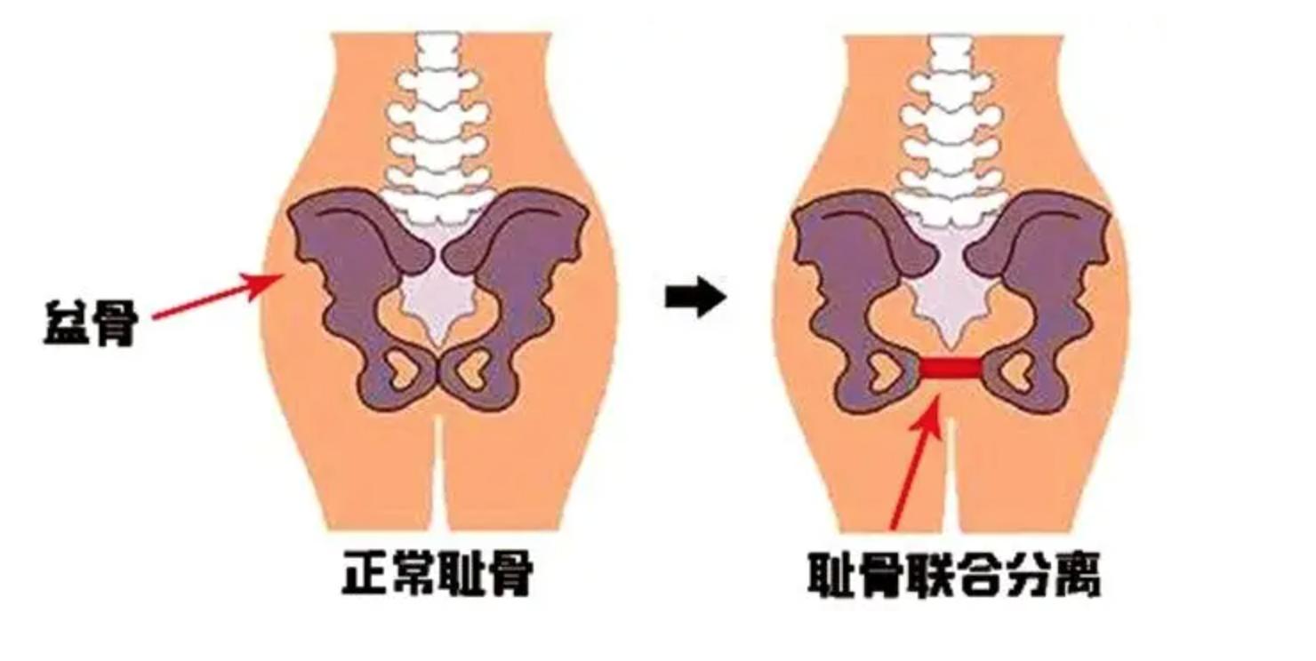 孕期耻骨痛怎么缓解,孕期耻骨痛怎么办缓解