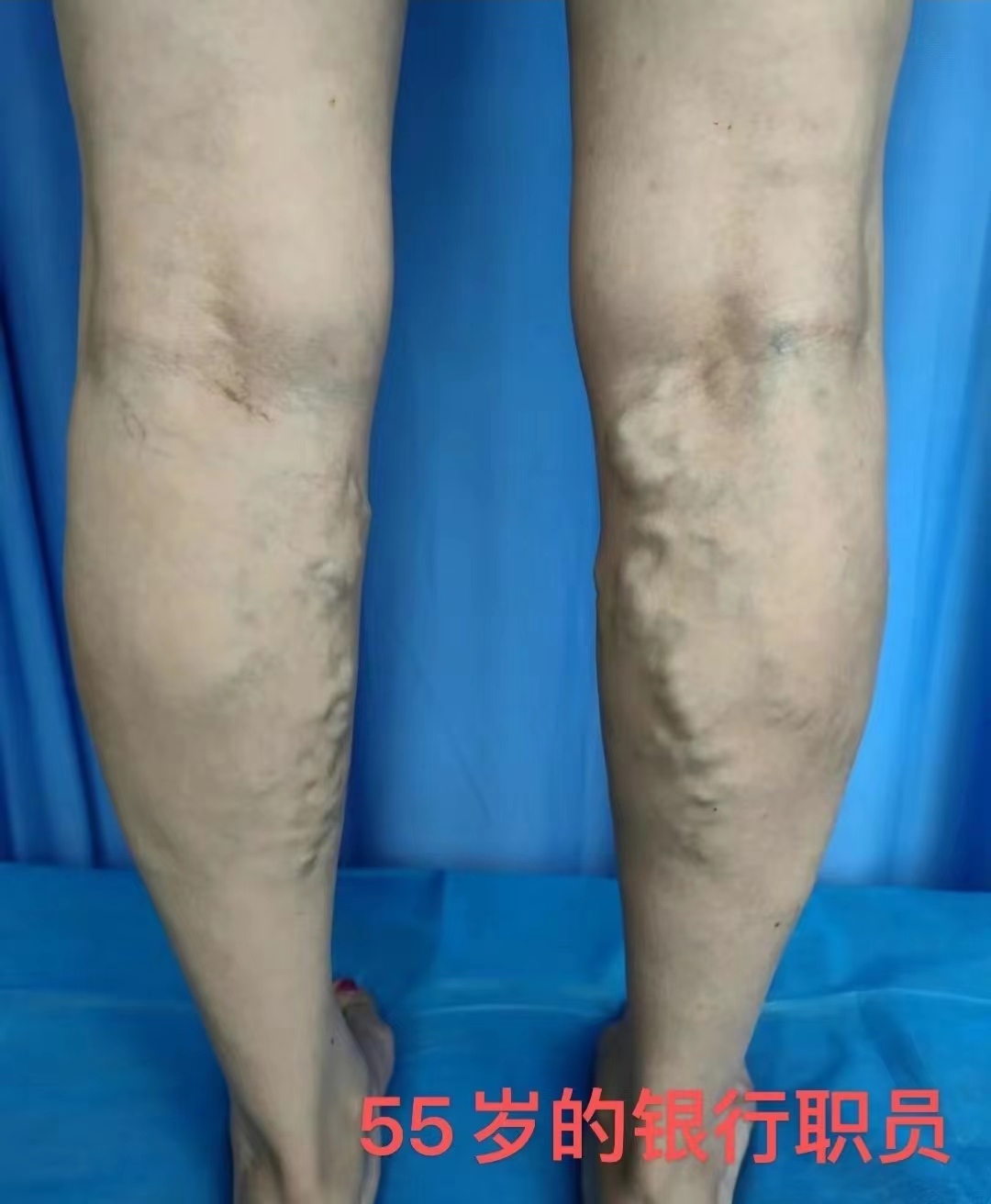 杨医生静脉曲张小视频,济南显微外科医院静脉曲张