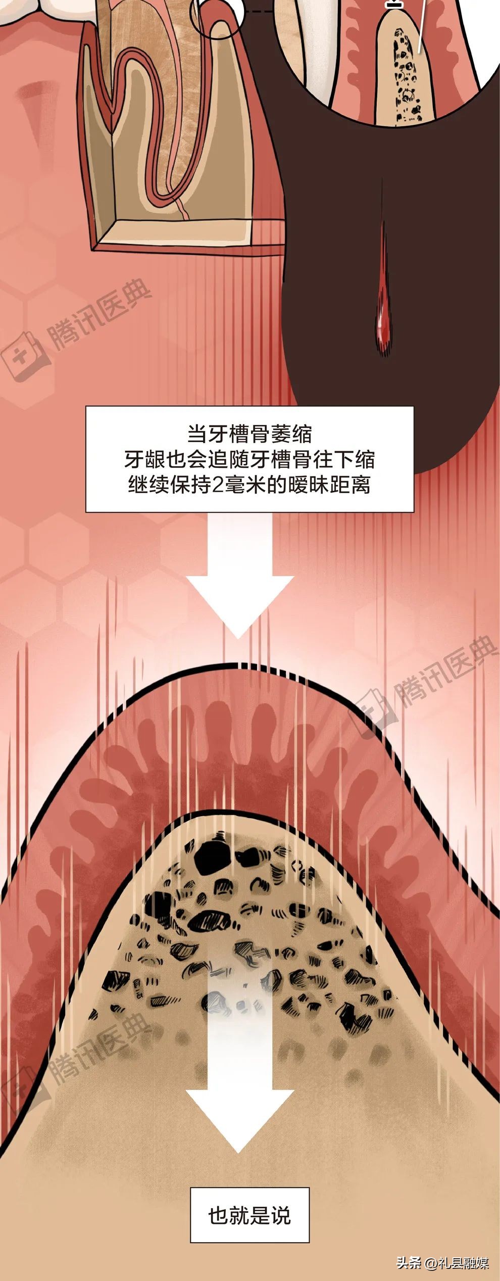 牙缝隙大吃菜就塞牙怎么修复,牙齿吃菜老塞牙怎么办