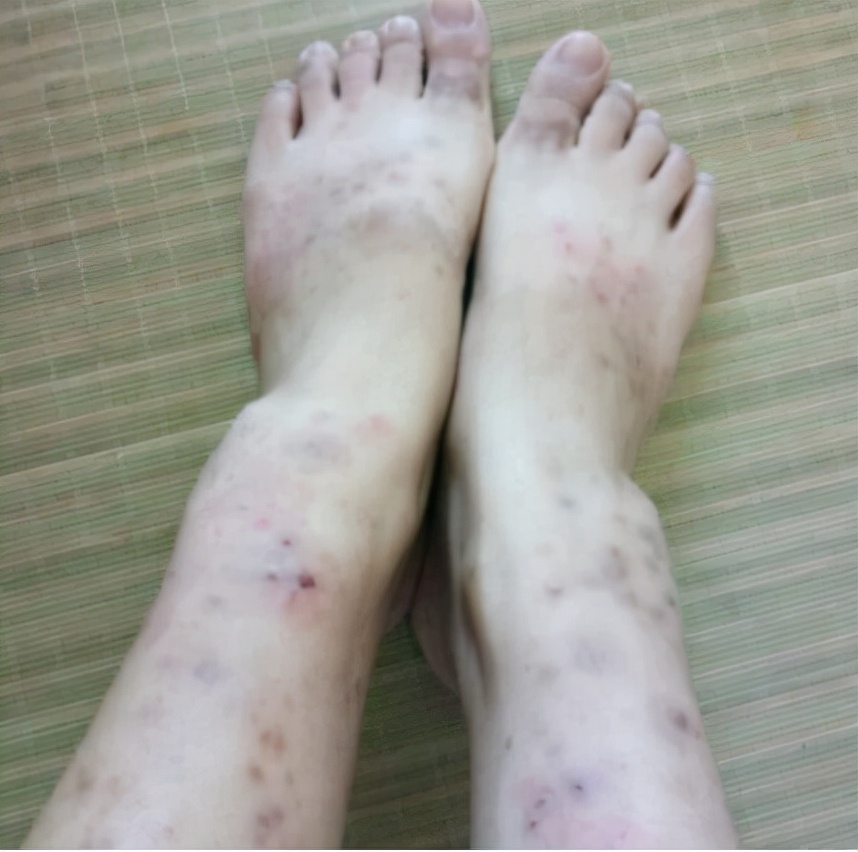 湿疹怎么处理注意这几点,湿疹的治疗方法和注意事项