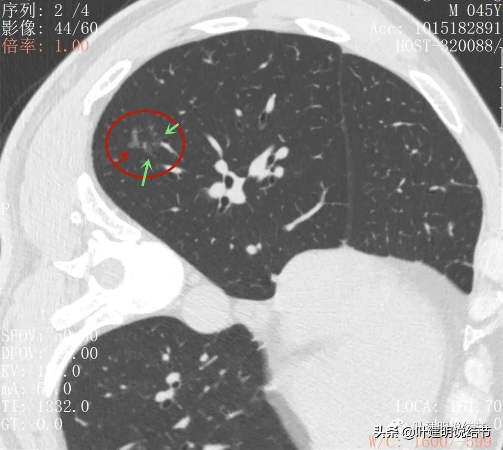 肺蜂窝状改变是肺癌吗,肺部陈旧灶与肿瘤怎么确诊