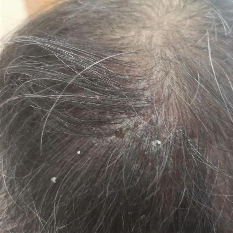 头屑多脱发怎么去除小妙招,头屑如何调理生发最有效