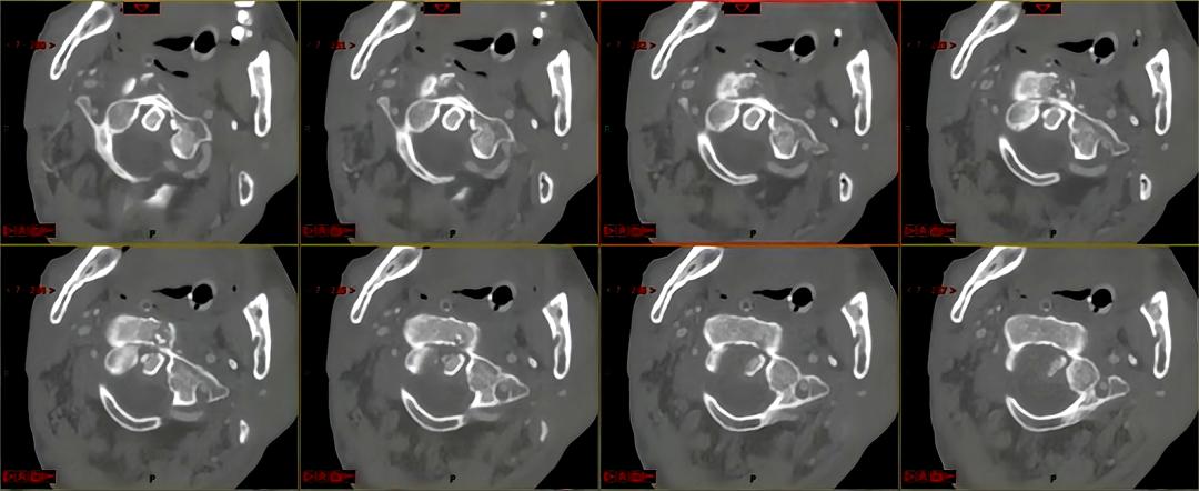 挑战骨折康复,颈椎如果摔断了会有什么后果