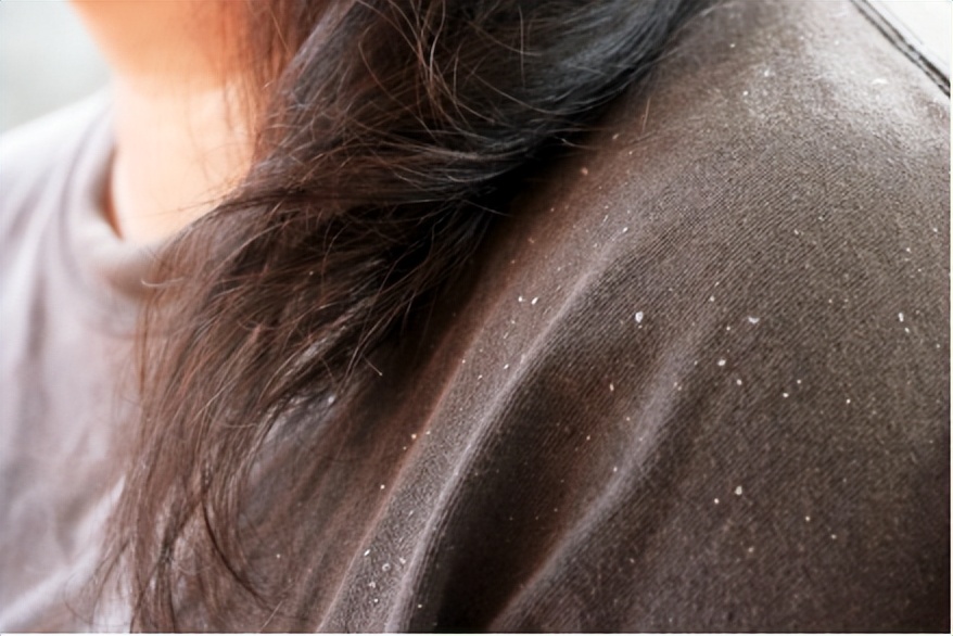 一到冬天头皮屑特别多吃什么药,冬天有头皮屑怎么能去掉小妙招