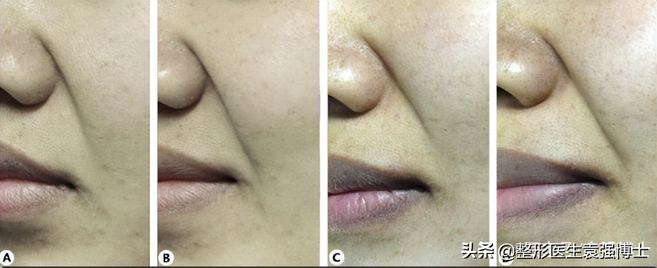 30多岁为什么法令纹那么严重,30岁左右法令纹严重怎么办