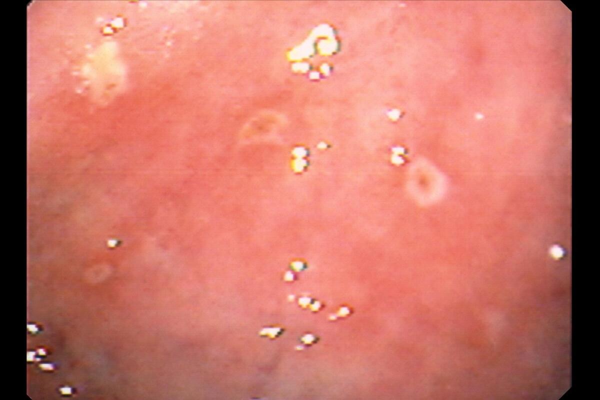 外阴白斑常见的并发症有哪些？