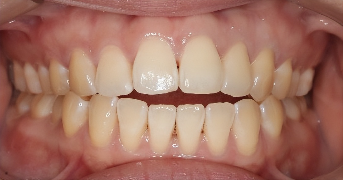 暑期牙齿矫正黄金季,牙齿矫正省钱攻略