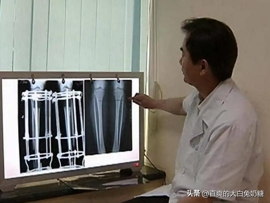 李亚诺断骨增高怎样了,断骨增高手术的李亚诺现状