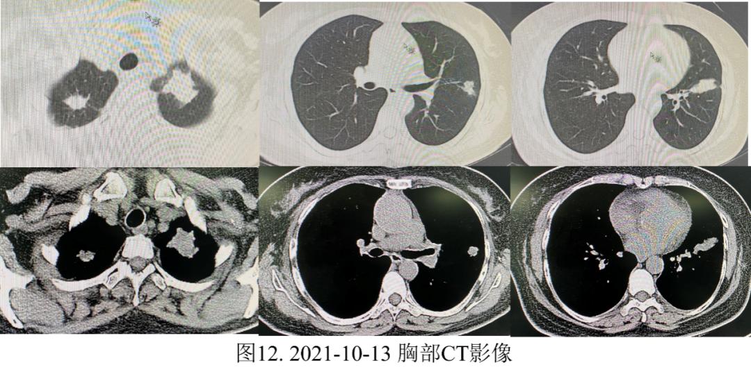 妇女双肺多发结节，病理示炎症，病情持续进展如何揭疑？