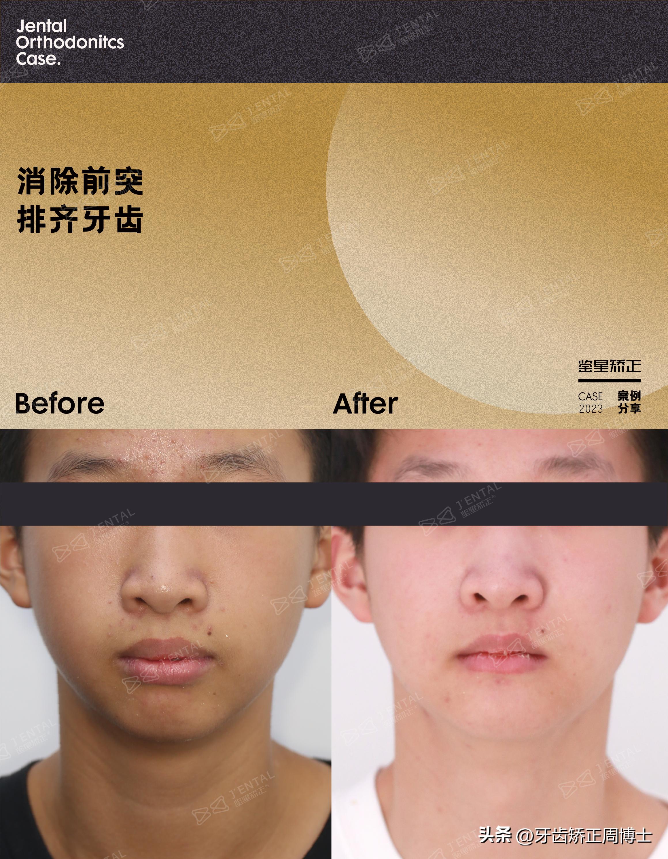 拔掉大牙做矫正好还是植牙好,拔掉4颗牙齿正畸收缝有几种方法