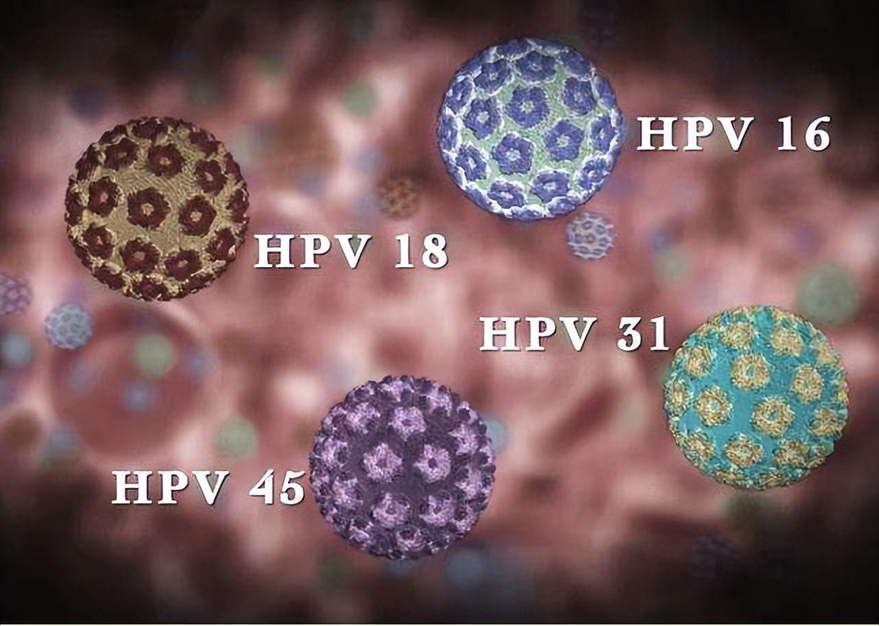45岁女子感染HPV，3个月*处私**长满“痘痘”！下身4种异常别再轻视