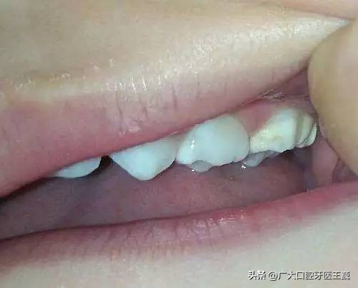 隐形牙套上面有白点,牙套上的白点是什么