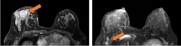 抗her2阳性治疗,双靶向治疗her2复发率