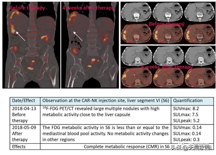 12年化疗失败，干细胞移植复发，CAR-NK疗法让癌症患者完全缓解