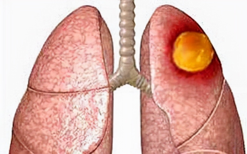 女52岁咳嗽咯血的ct诊断,老是咳嗽结果是肺脓肿