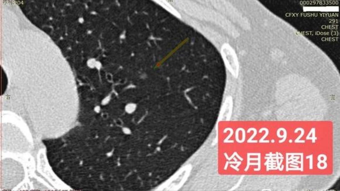 7mm肺结节恶性的怎么办,7mm实性肺结节危险程度