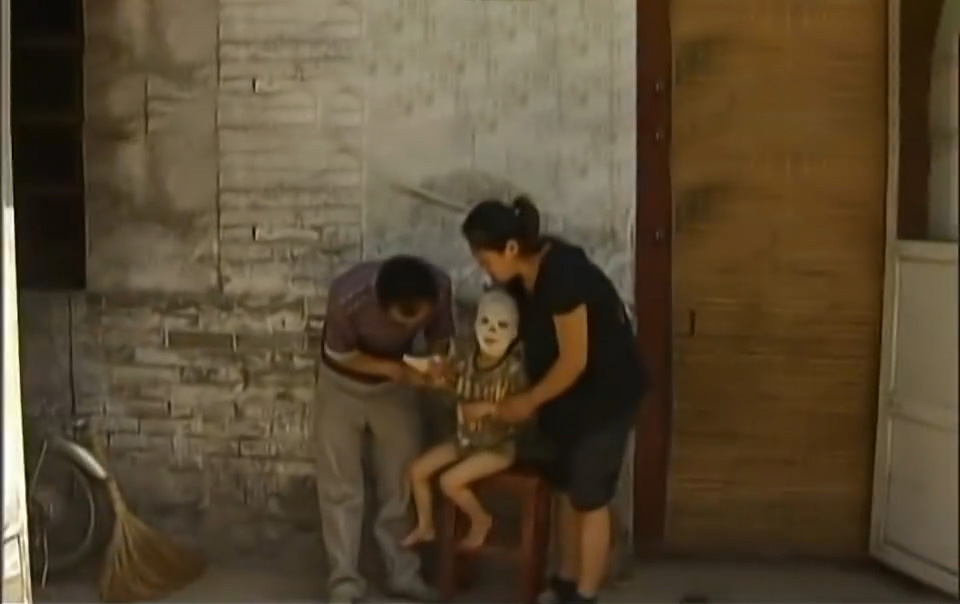 男孩因为烧伤惨遭毁容,被烧伤毁容的男孩