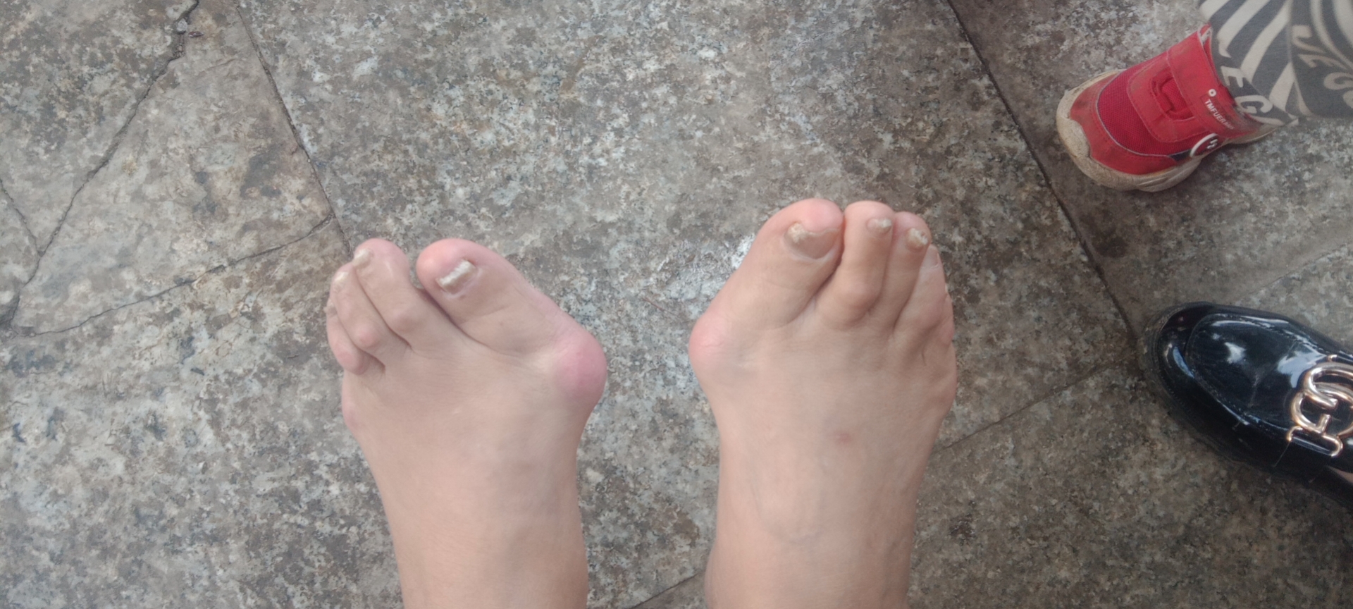 一个脚正常一个脚拇外翻,脚小趾拇外翻是怎么回事