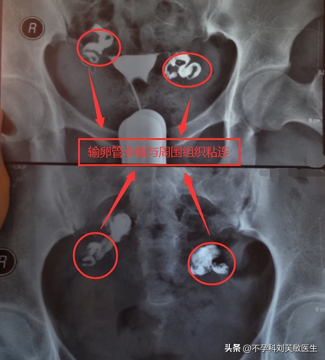 输卵管造影怎么看片子图解,最新的输卵管造影方法
