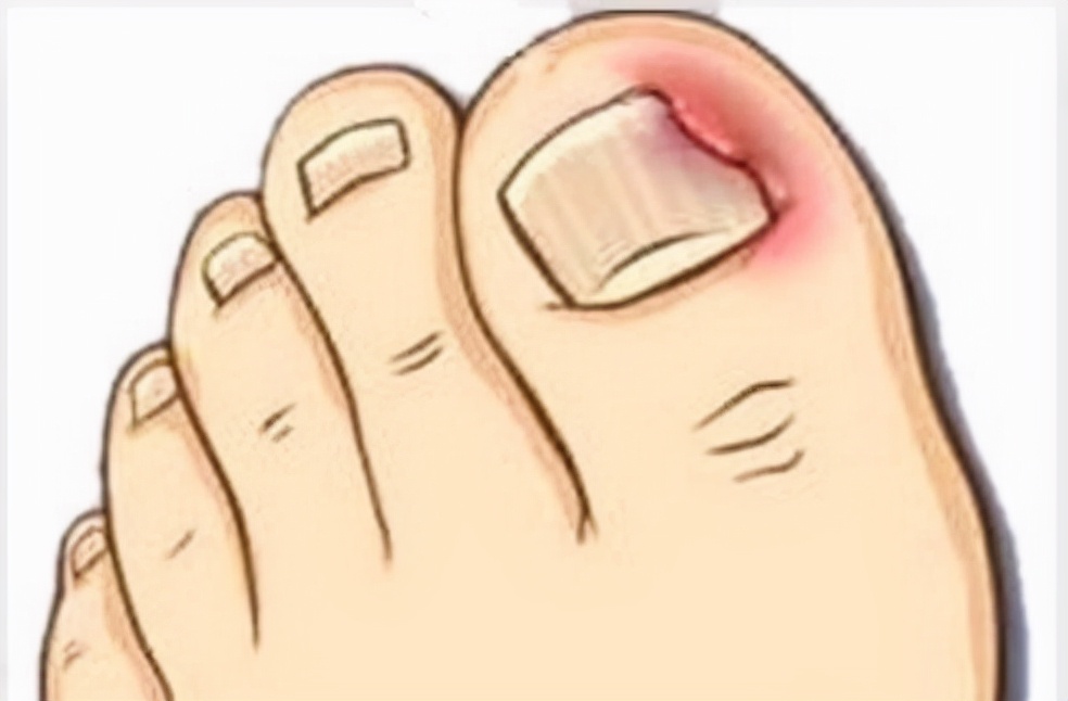 甲沟炎脚趾疼怎么缓解,足部甲沟炎怎么消肿