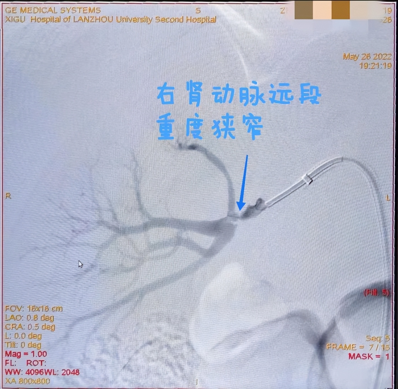 关注青年高血压关注肾动脉狭窄——兰大二院西固医院神经外科成功完成经皮肾动脉狭窄球囊扩张成形术