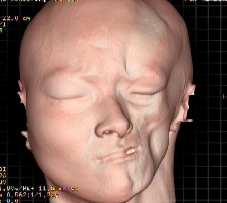 二十岁花季少女毁容手术,重庆15岁花季少女被毁容之后