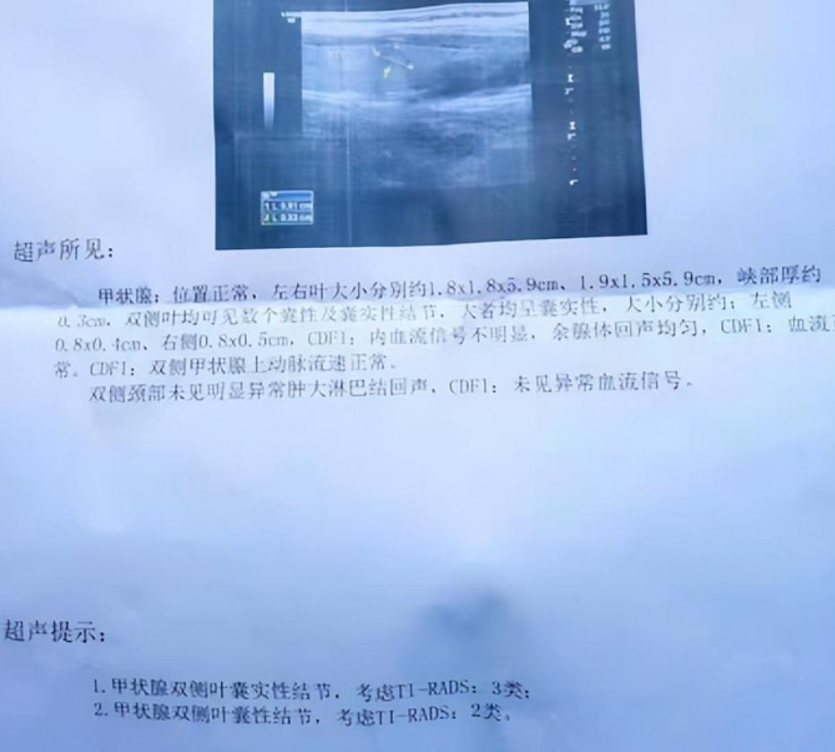 甲状腺消融后饮食方面,甲状腺结节消融术后饮食注意什么