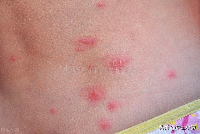 绝经后外阴和肛门连接处瘙痒,绝经后外阴萎缩瘙痒是正常表现吗