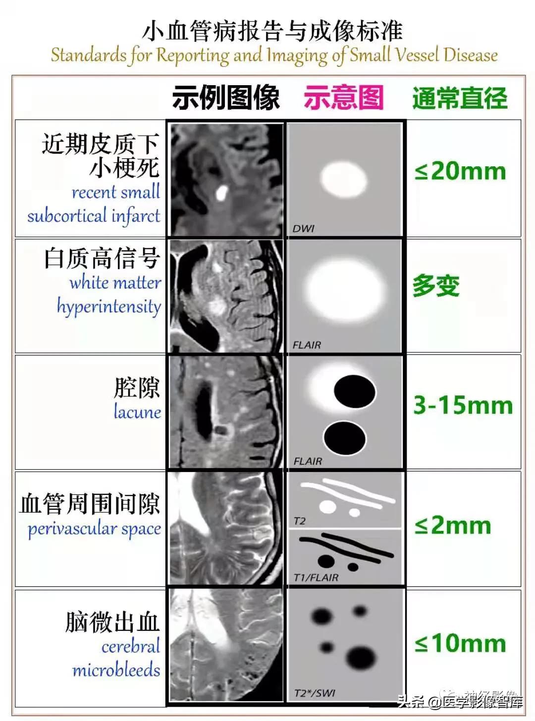 腔隙灶腔梗,陈旧性颅内腔梗灶是什么意思