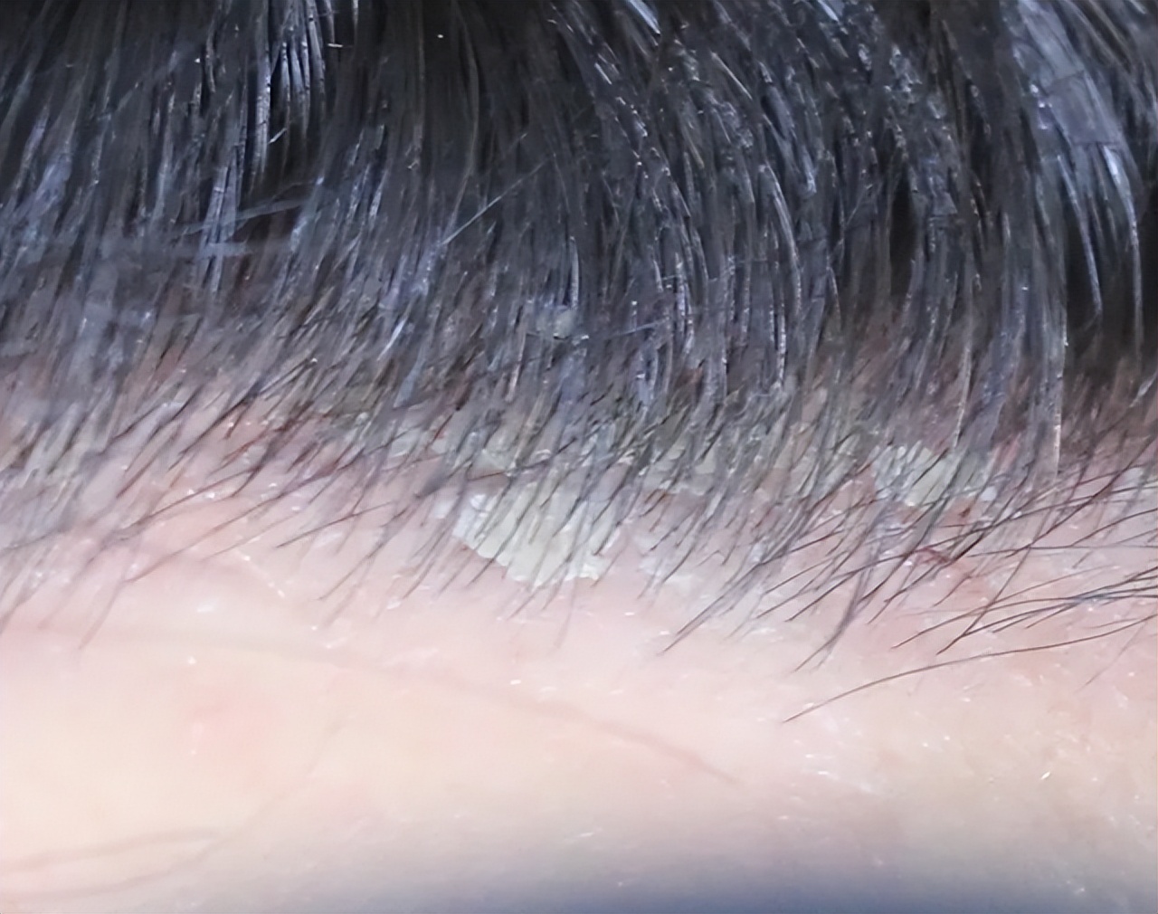 头皮上经常长脓包,头皮经常起疙瘩有脓包是什么原因