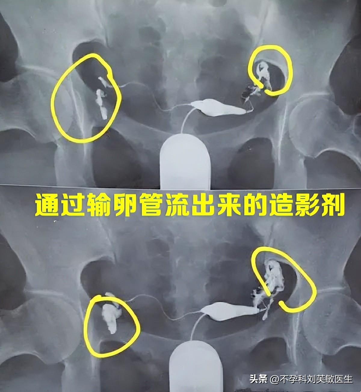 输卵管造影怎么看片子图解,最新的输卵管造影方法