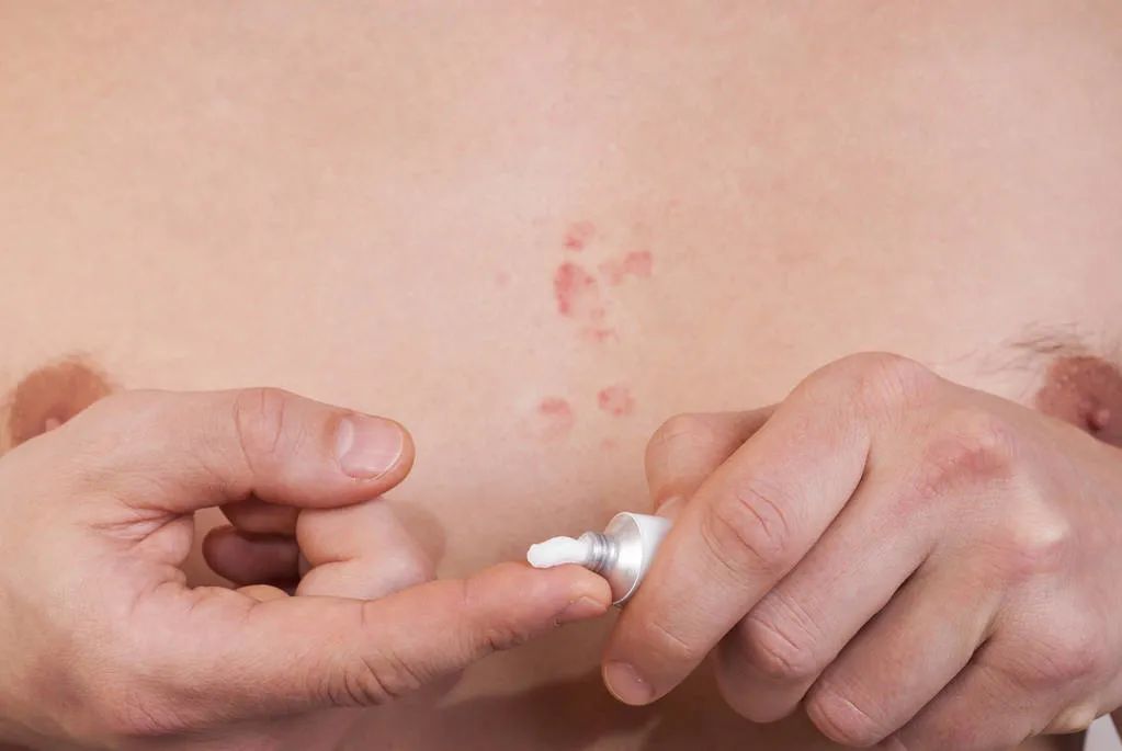 湿疹症状有哪些？湿疹原因、预防一次看，4招有效止痒