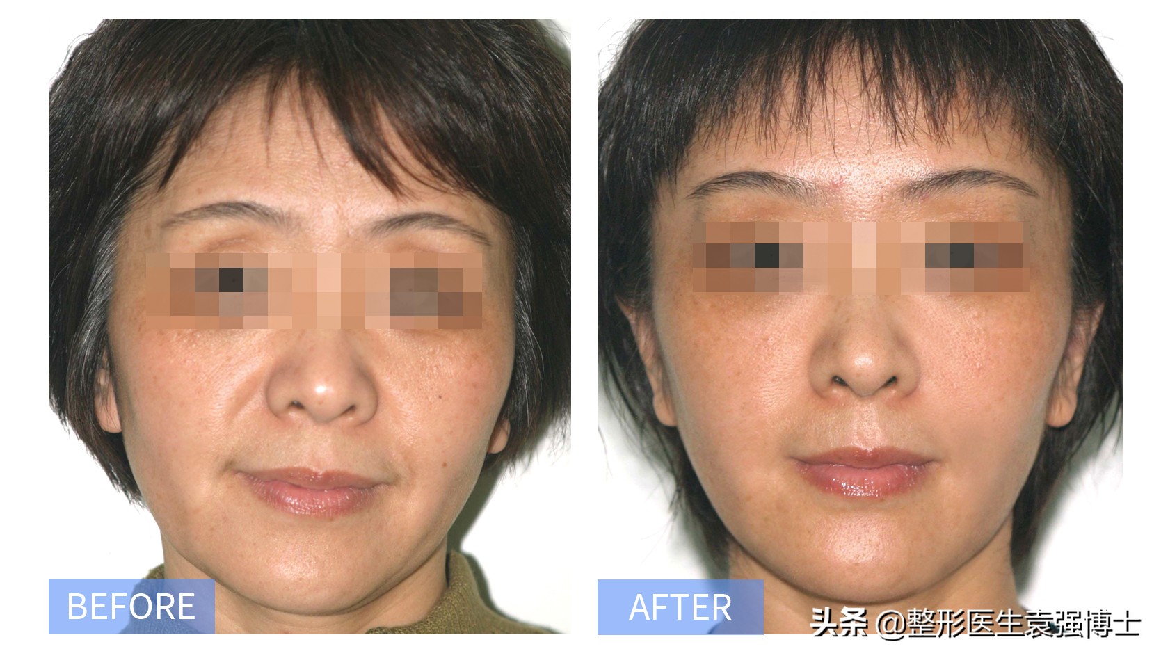 拉皮手术属于什么美容项目,拉皮手术哪个医生好