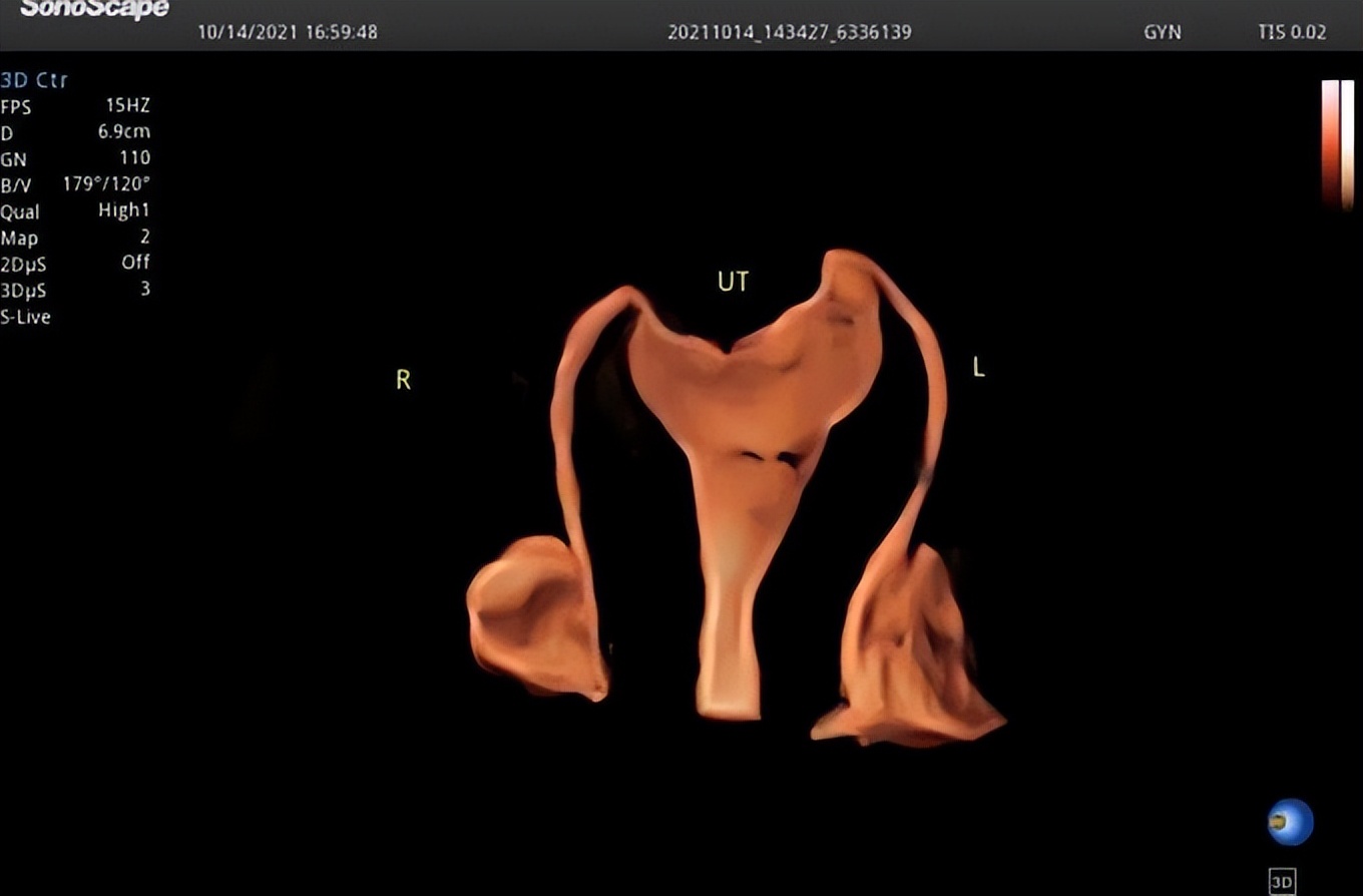 南昌妇幼保健院输卵管无痛造影,子宫输卵管超声造影的检查准备