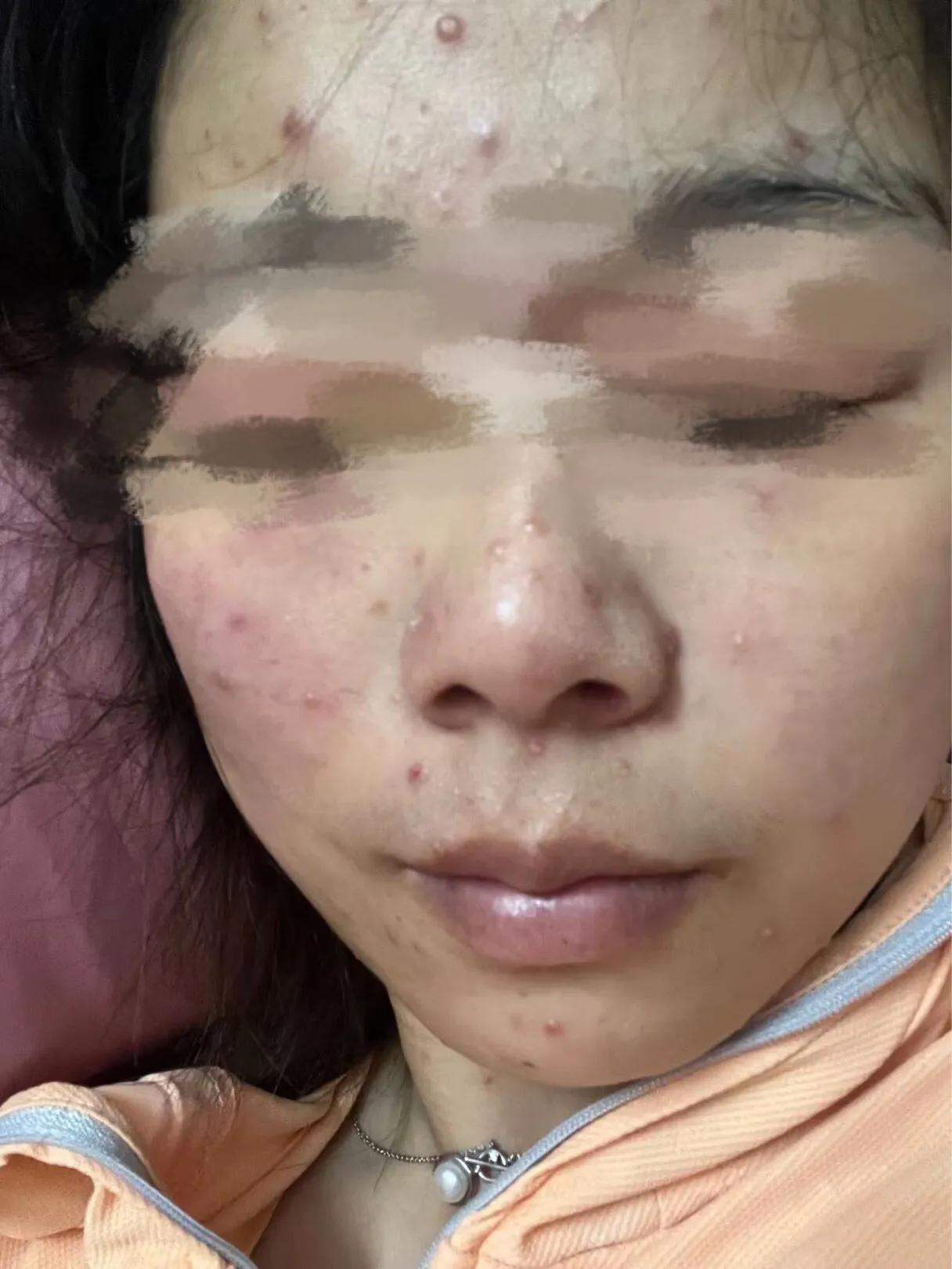 猴痘病毒水痘,水痘带状疱疹病毒感染季节