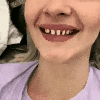 明星嘴突戴牙套前后对比,明星和假牙