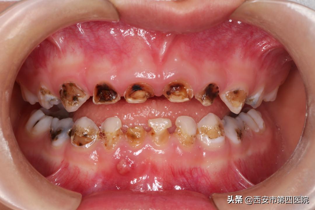 健康中国儿童青少年健康行动方案,6岁孩子大牙龋齿要不要处理