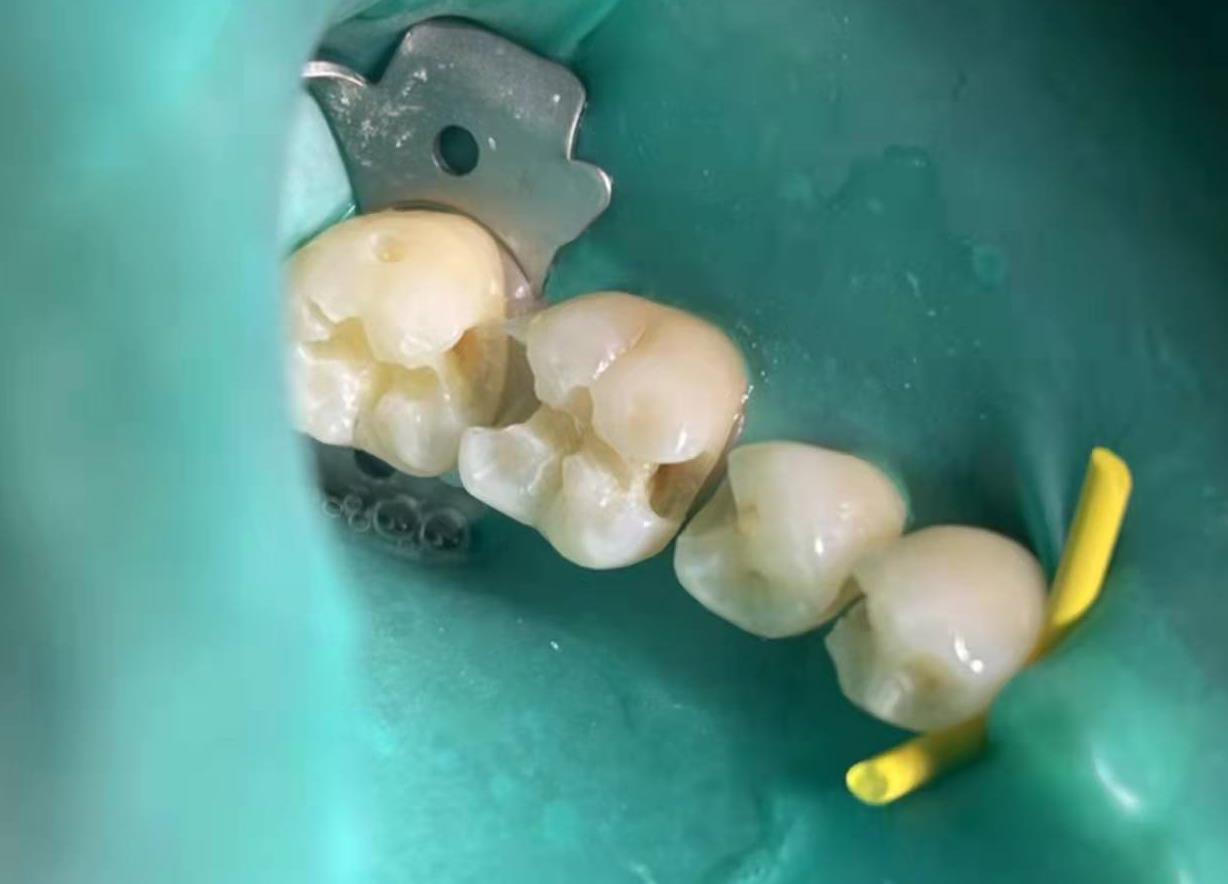 在北京房山种植牙怎么选,房山口腔牙科种植牙价格表