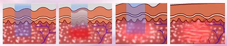 青春痘逆袭的方法,16岁青春期学生痘印如何改善